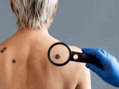 Maj u znaku borbe protiv melanoma, besplatni pregledi u UKC RS 29. maja