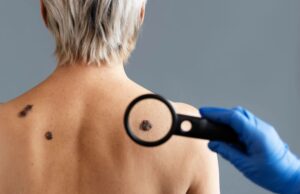 Maj u znaku borbe protiv melanoma, besplatni pregledi u UKC RS 29. maja